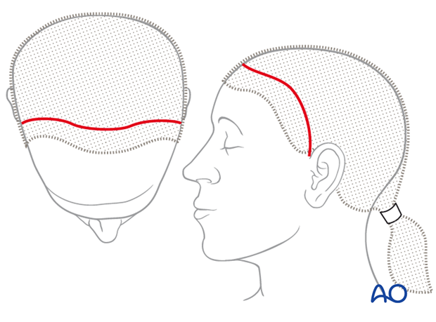 Anteriorly over the vertex placed incision