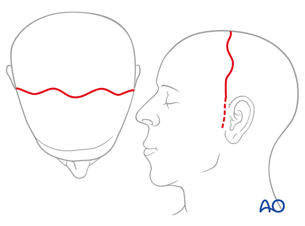 Wave pattern incision design