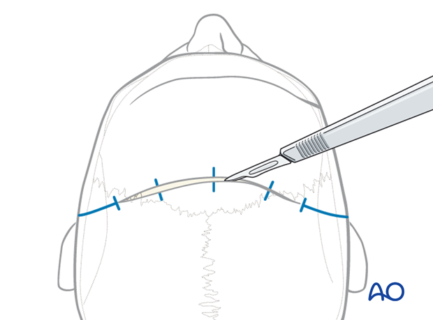 The incision is made with a No. 10 blade