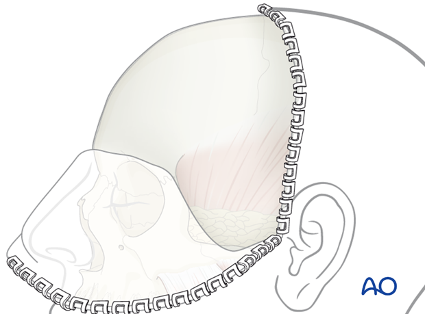 Inside out turned coronal flap