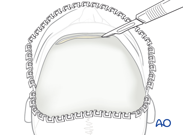 Cross-forehead horizontal incision