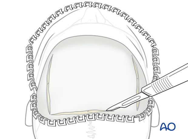 Bilaterally incisions along the superior temporal lines from the anterior to posterior extent of the exposed surface