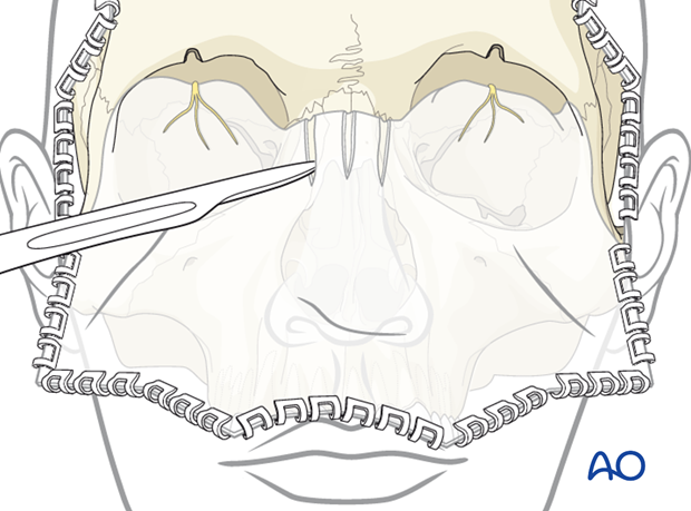 Subperiosteal Exposure of the orbits and upper midface