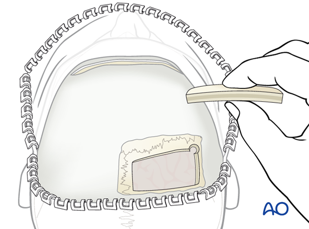 Harvesting cranial bone grafts