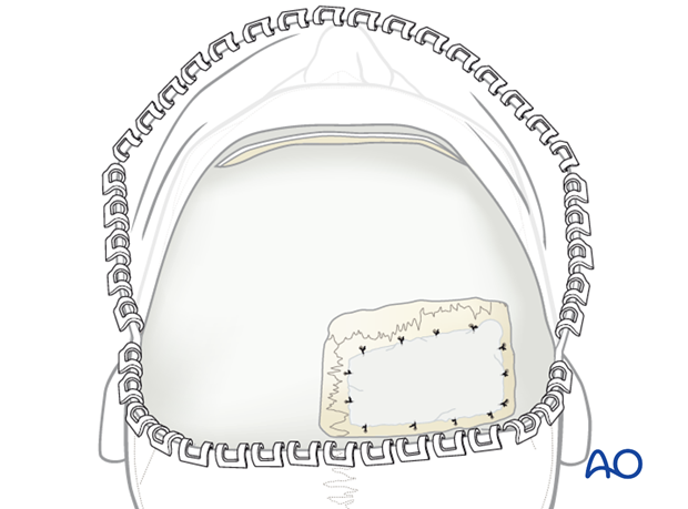 Harvesting cranial bone grafts