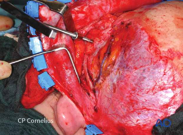 Incision behind the ear along the postauricular fold and the resulting exposure of the zygomatic arch and the zygoma