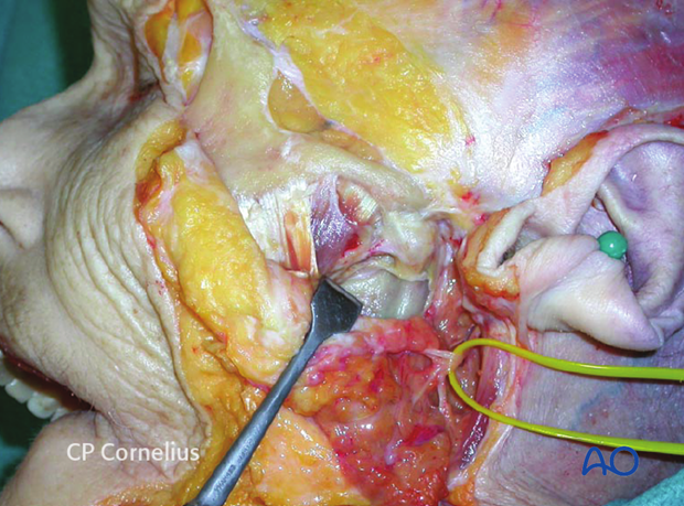 Exposure of the temporomandibular joint and/or mandibular condyle/ramus