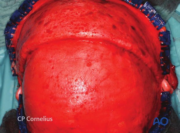 Continued dissection of the coronal flap to the level of the supraorbital rims