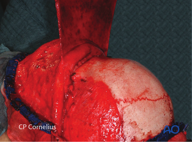 Development of pericranial flap