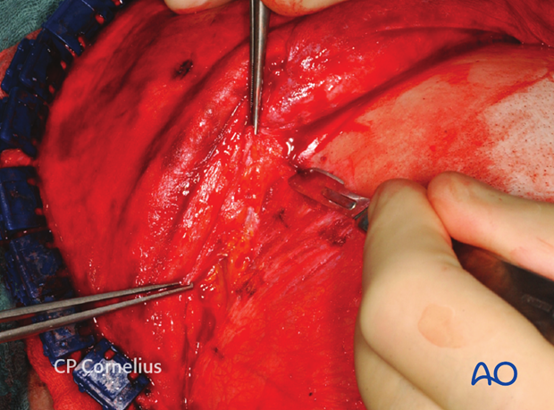 Incision of the superficial temporal fascia for exposure of the zygomatic arch 