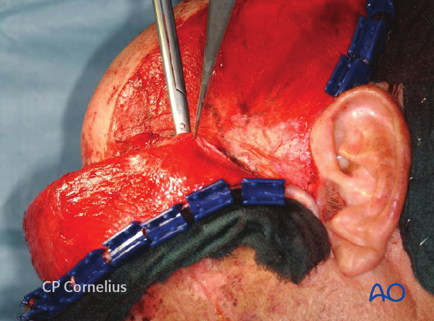 Incision of the superficial temporal fascia for exposure of the zygomatic arch 