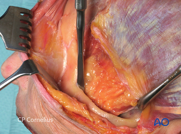 Incision of the superficial temporal fascia for exposure of the zygomatic arch 