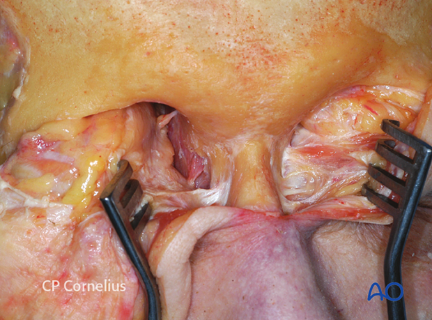 Subperiosteal exposure of the orbits and upper midface
