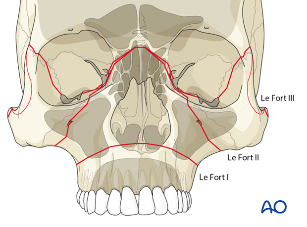 AOCMF Classification Midface (Level 1 and 2)