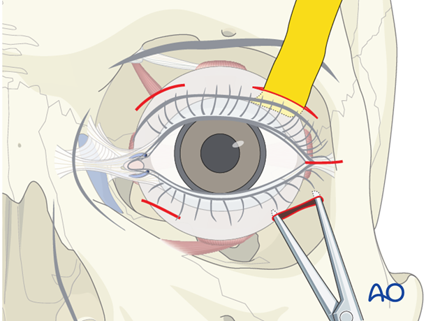 orbital reconstruction