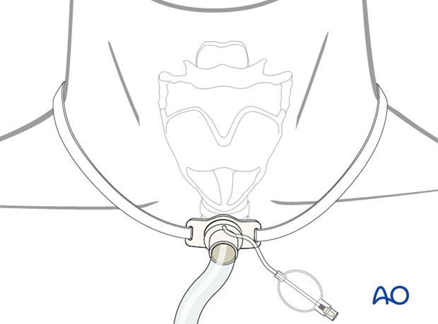 Airway considerations