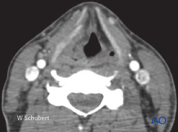 Airway considerations