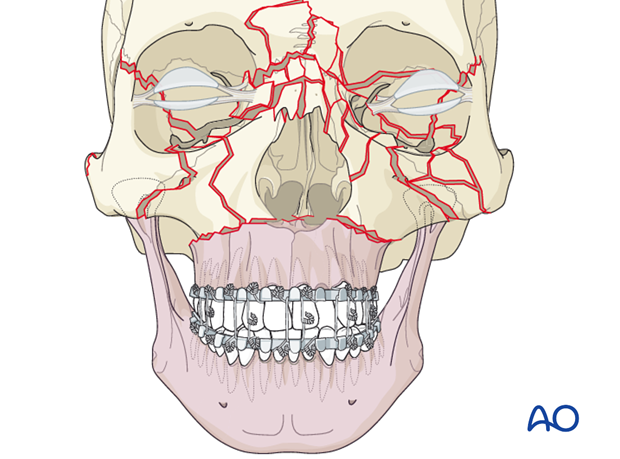 panfacial fractures sequencing of repair