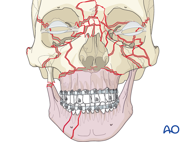 panfacial fractures sequencing of repair