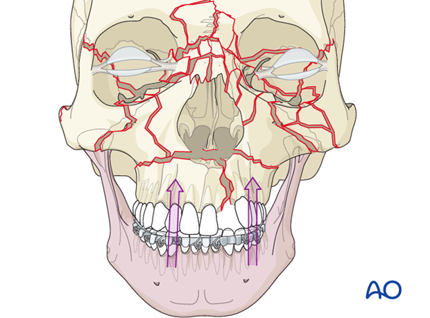 panfacial fractures sequencing of repair