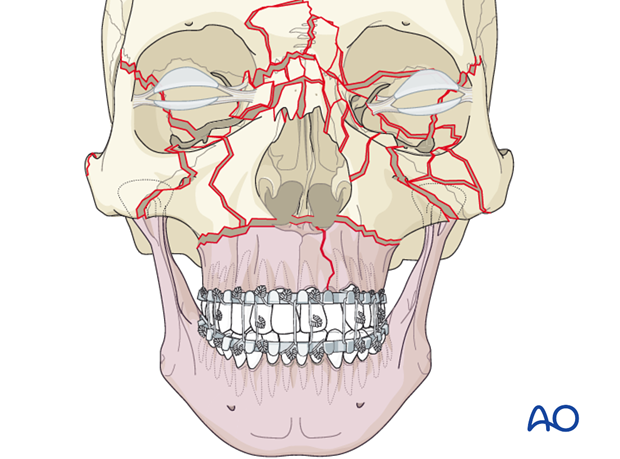 panfacial fractures sequencing of repair