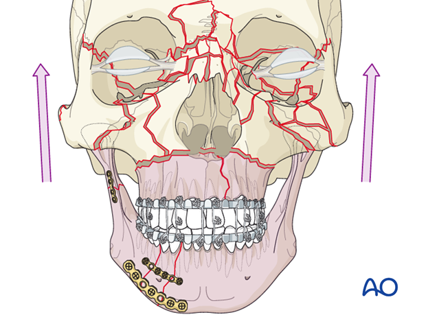 panfacial fractures sequencing of repair