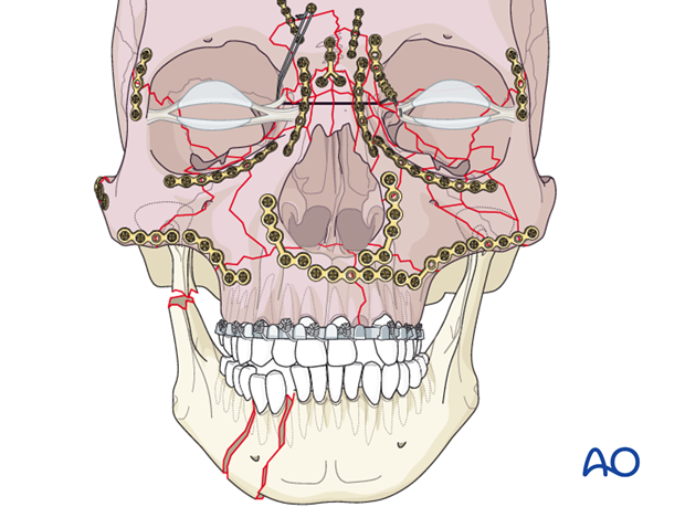 panfacial fractures sequencing of repair