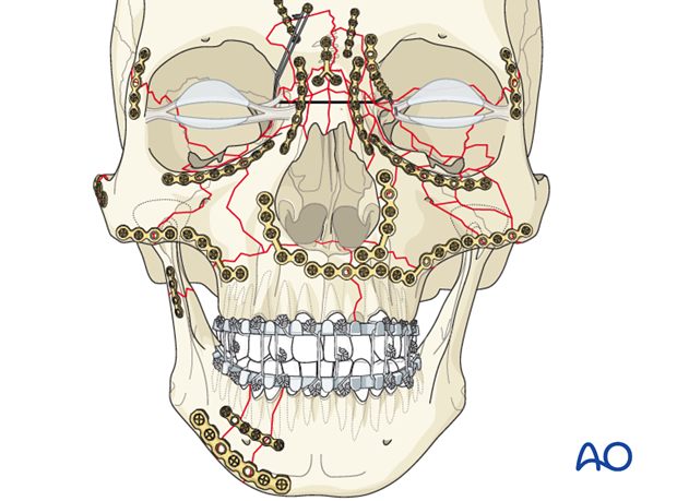 panfacial fractures sequencing of repair