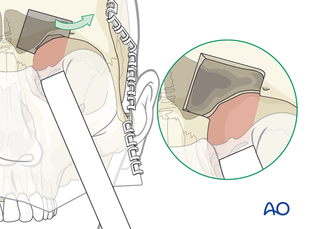 adjunctive access procedures orbitotomies