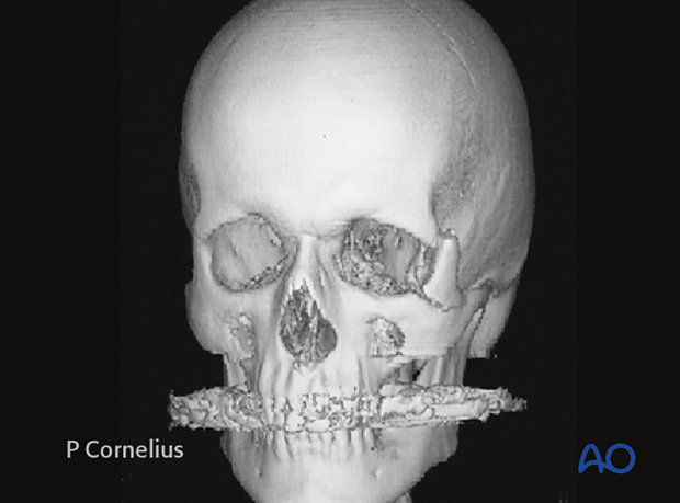 adjunctive access procedures orbitotomies