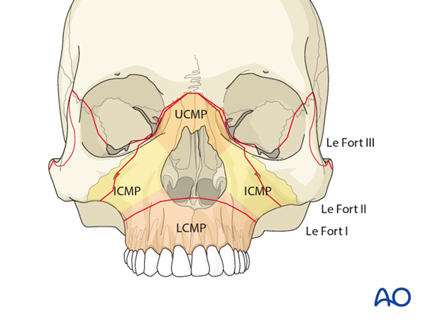 AOCMF Classification Midface (Level 1 and 2)