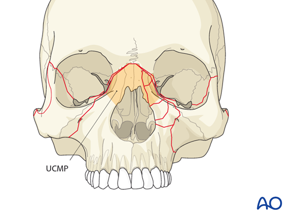 AOCMF Classification Midface (Level 1 and 2)