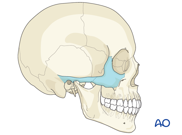 AOCMF Classification Midface (Level 1 and 2)