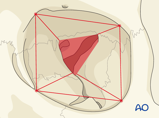 AOCMF Classification Midface (Level 1 and 2)