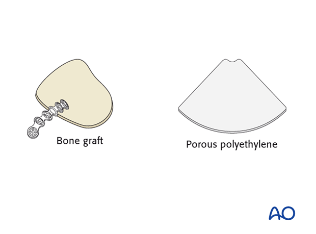 choice of implants