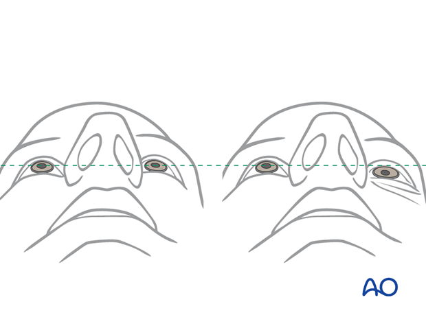 examination of patients with midfacial injuries