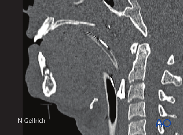 Airway considerations