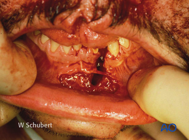 examination of patients with midfacial injuries