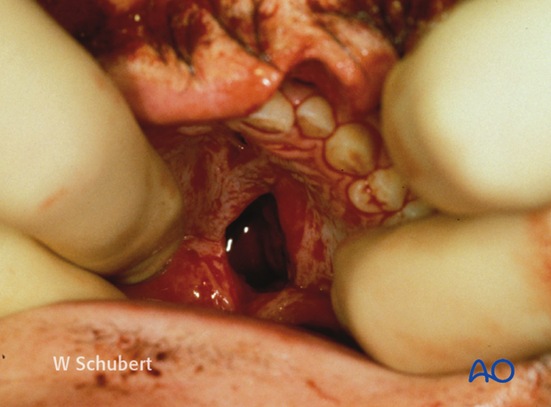 examination of patients with midfacial injuries