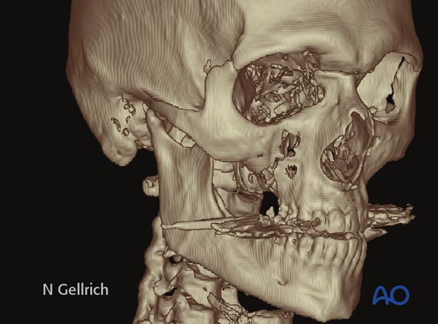 examination of patients with midfacial injuries