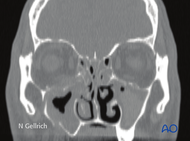 examination of patients with midfacial injuries