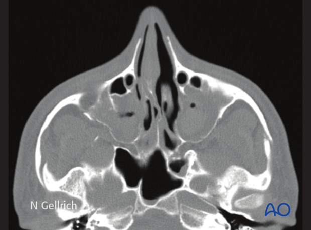 examination of patients with midfacial injuries