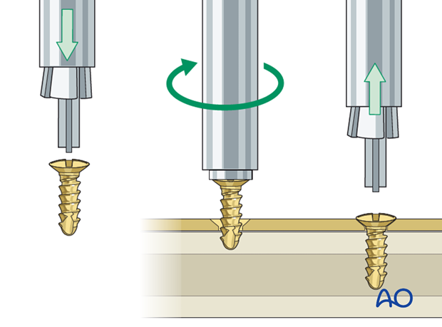 choice of implants