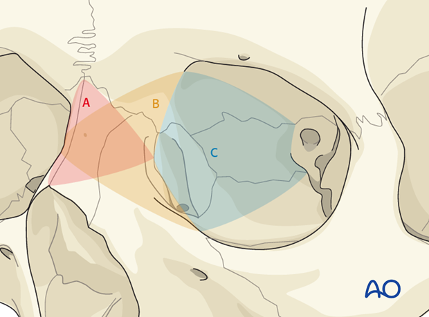 Extended glabellar approach