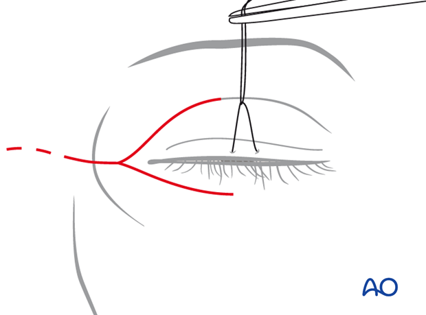 Extended glabellar approach