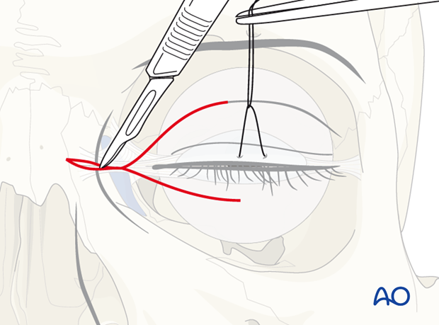 Extended glabellar approach