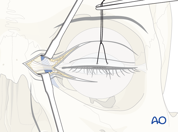 Extended glabellar approach