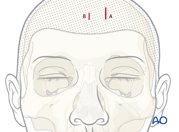 Endoscopic approach to the anterior table