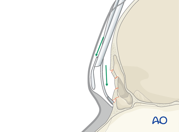 Endoscopic approach to the anterior table