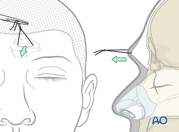 Endoscopic approach to the anterior table